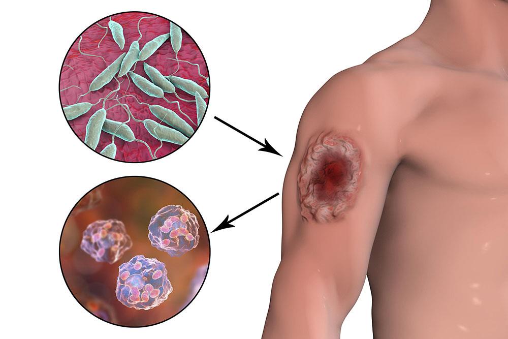 بیماری لیشمانیوز (Leishmaniasis)