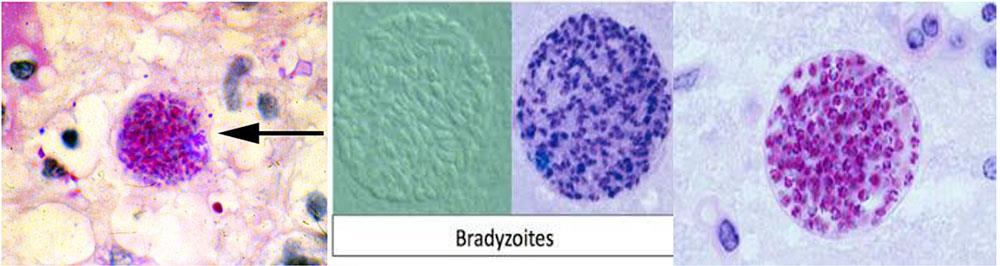 کیست‌های بافتی در مغز (Bradyzoites)